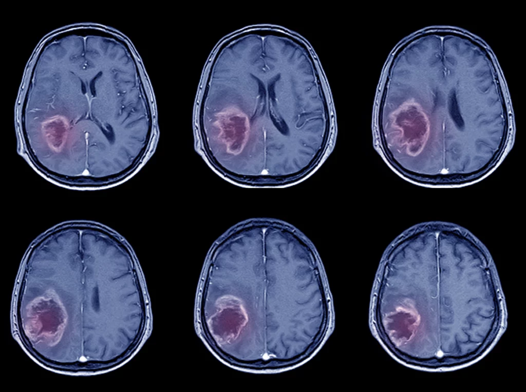 МРТ головного мозга Киев Док Лайф диагностика головы МРТ головы Осокорки опухоль