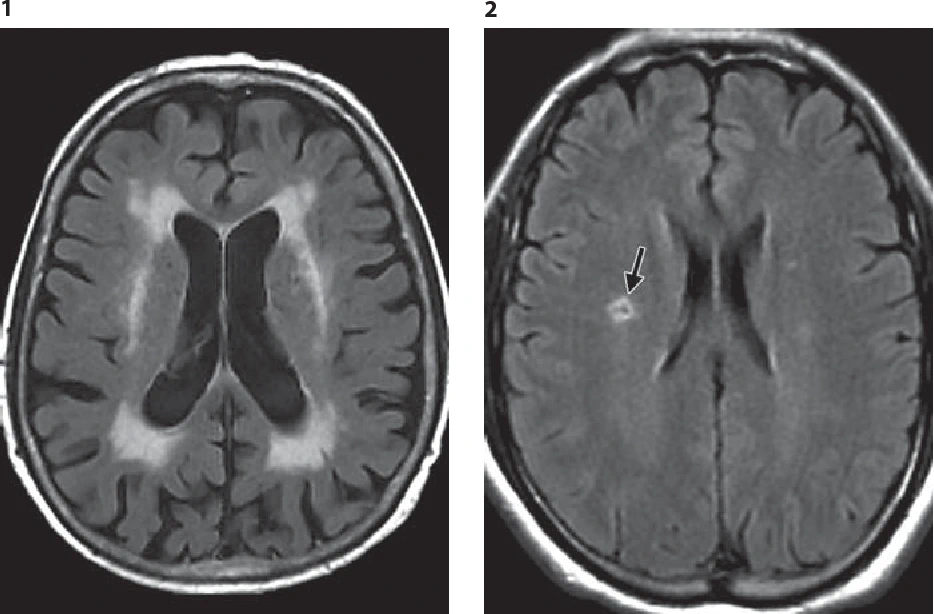 Микроангиопатия Головного Мозга 3 Степени МРТ Микроангиопатия головного мозга Док Лайф Киев