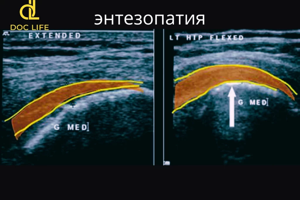 что такое Энтезопатия причины, симптомы и диагностика УЗИ Киев