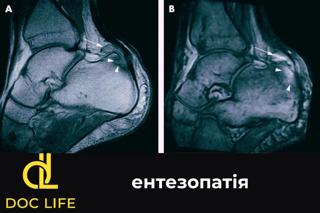 Энтезопатия Энтезопатия в Киеве — МРТ, УЗИ и эффективное лечение сухожилий
