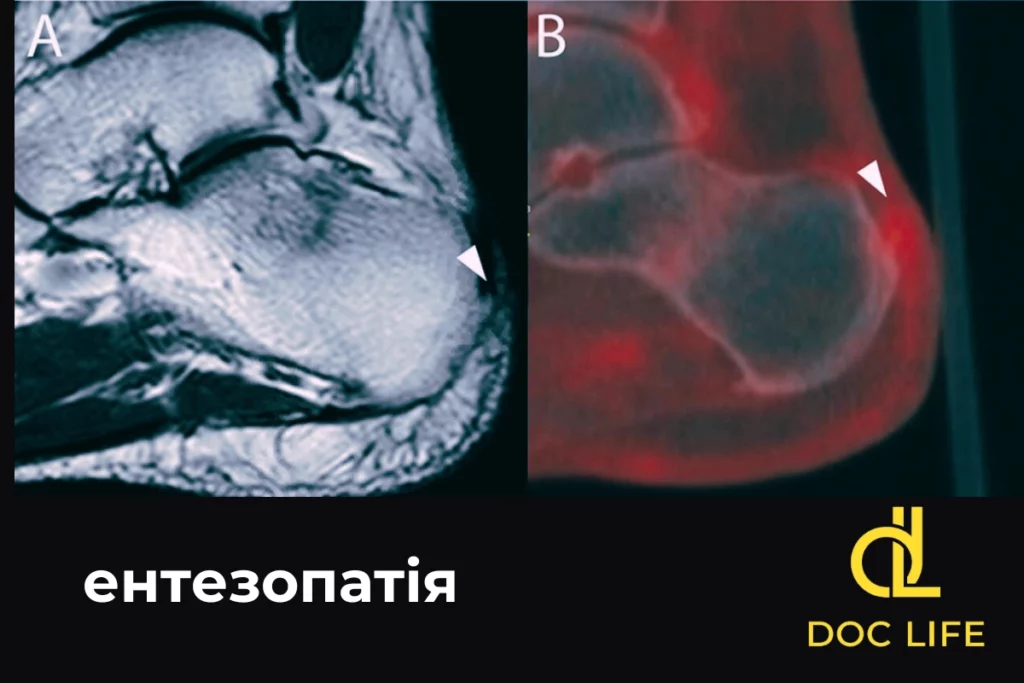 что такое Энтезопатия причины, симптомы и диагностика Киев