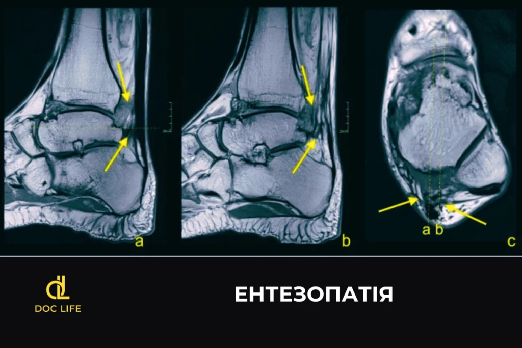 энтезопатия диагностика в Киеве 