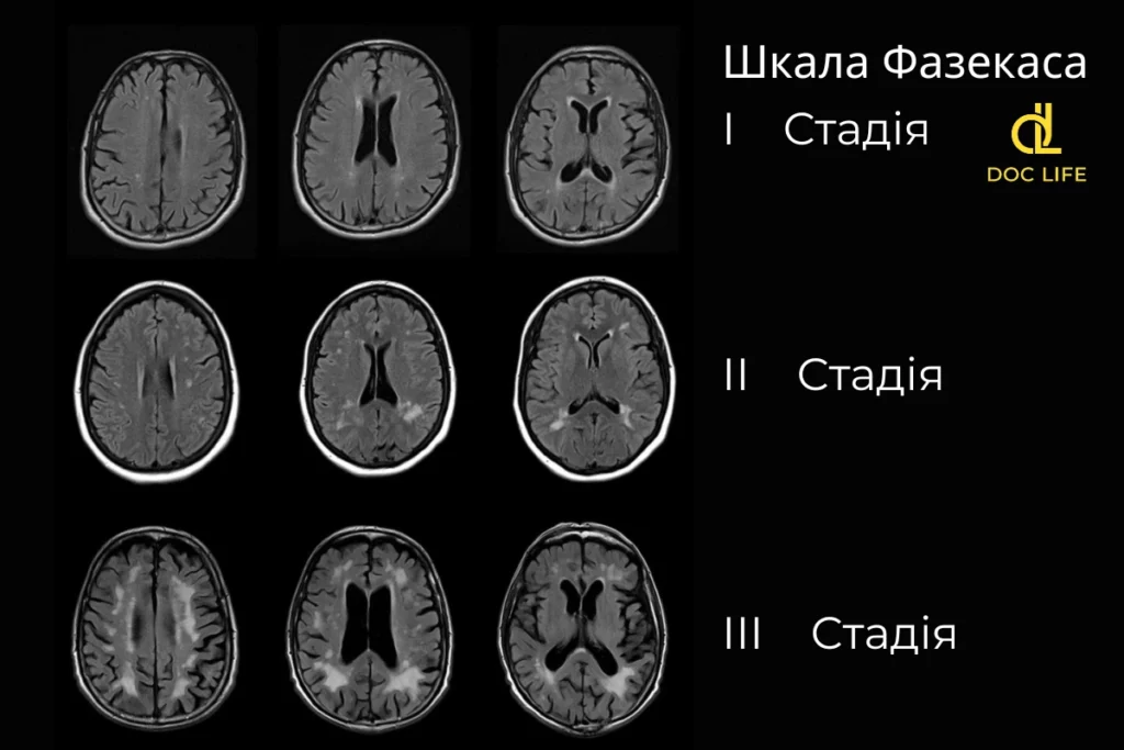 Консультация нейрохирурга Наталии Анатолиевны Скижа Fazekas scale for white matter lesions