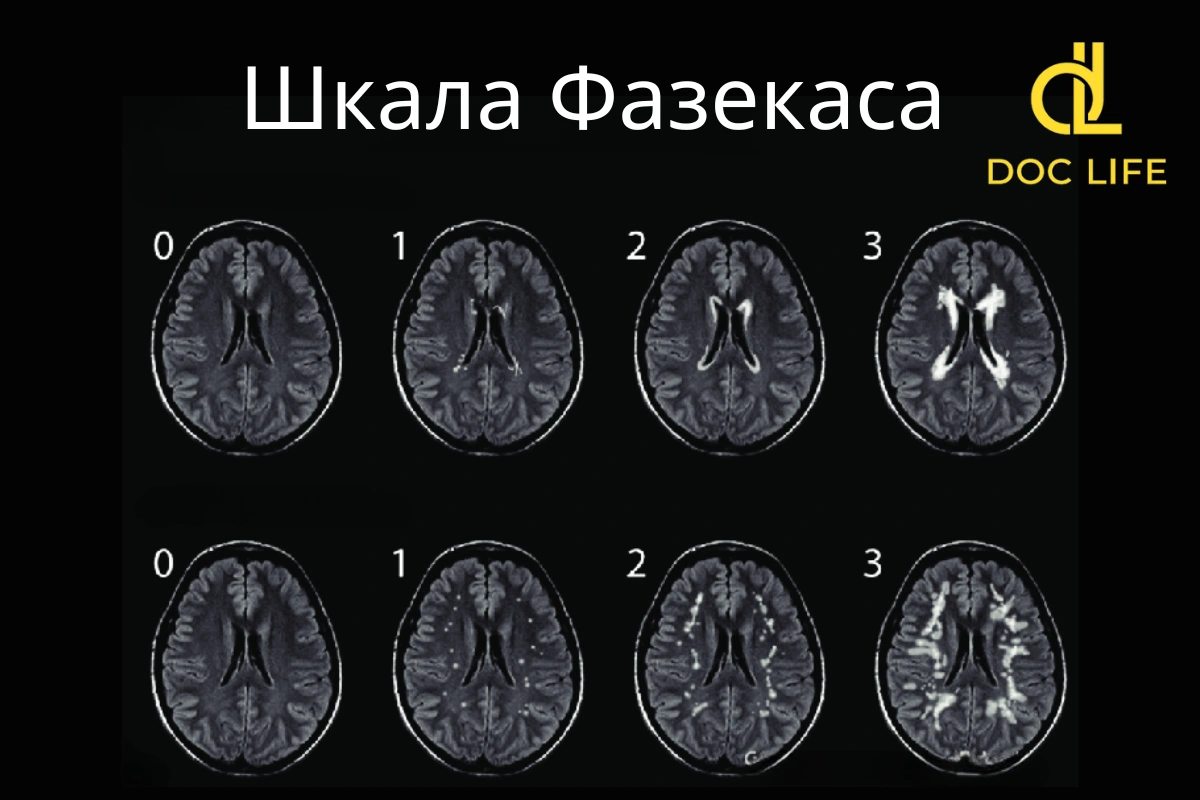 нейрохірургія фазекас Fazekas scale for white matter lesions