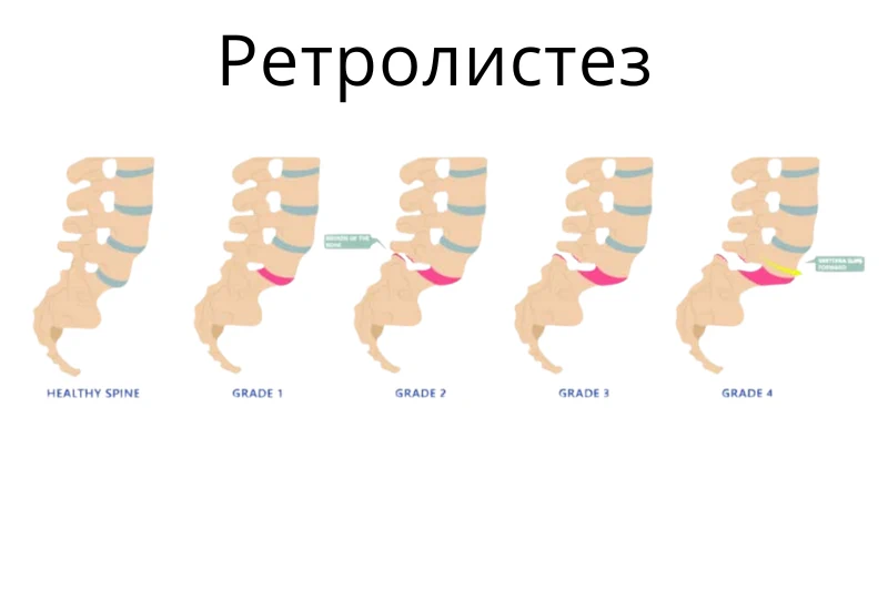 Визуализация ретролистеза L5 на КТ с 3D-реконструкцией Клиника Док Лайф Осокорки Позняки Киев