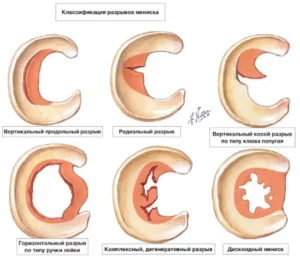 подготовиться к МРТ Stoller 3a: комментарии нейрохирурга Наталии Анатолиевны Скижа