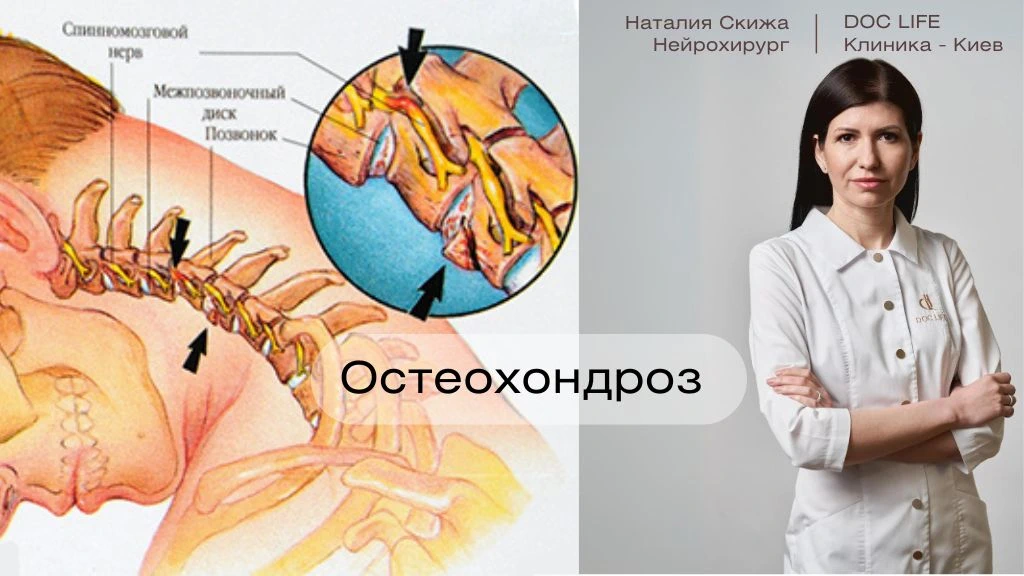 Спондилез - степени, стадии, причины, симптомы, признаки, лечение