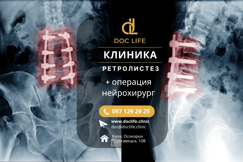 Ретролистез L5 малоинвазивное лечение в клинике Doc Life киев Позняки Осокорки