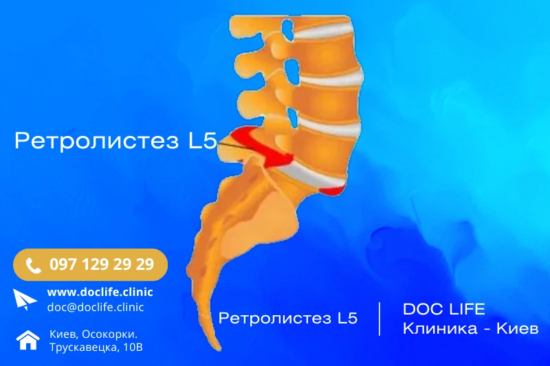 Ретролистез Ретролистез L5 визуализация на МРТ позвоночника.