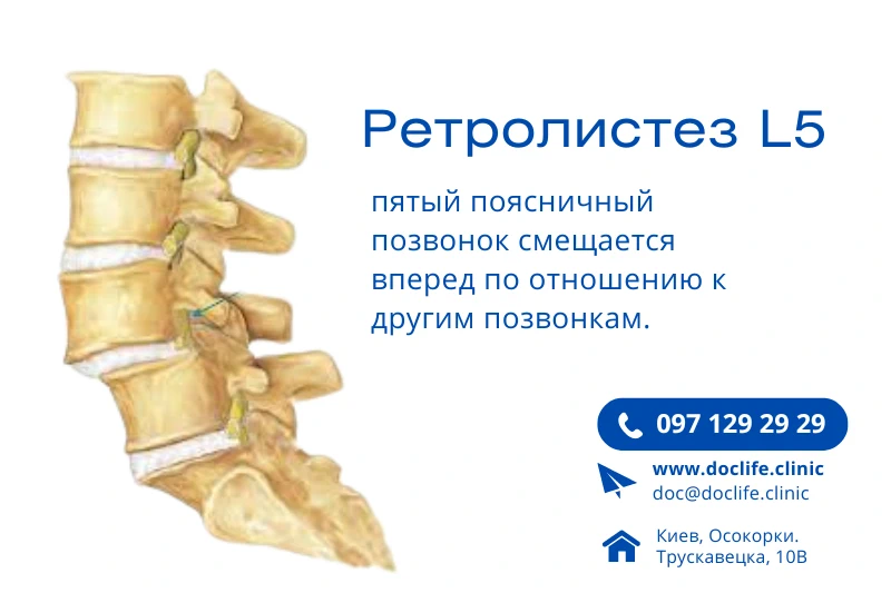 Симптомы ретролистеза L5 описание и визуализация Киев Позняки клиника Док Лайф