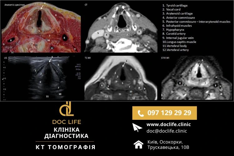 КТ гортани в Киеве — Компьютерная томография горла с контрастом Осокорки Позняки
