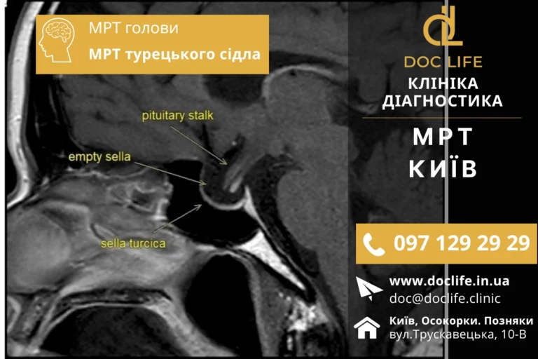 Пустое турецкое седло головного мозга. Диагностика МРТ турецкого седла