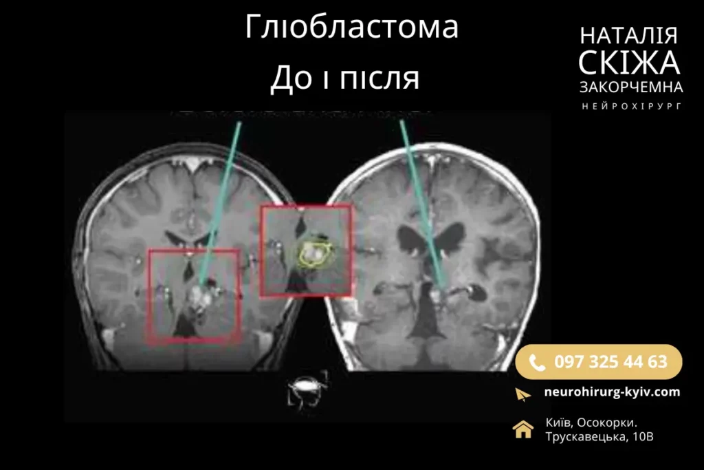 Глиобластома диагностика МРТ головного мозга с контрастом