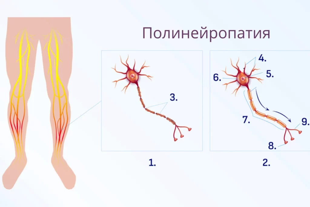 Полинейропатия консультация причины симптомы диагностика и лечение Невролог 2