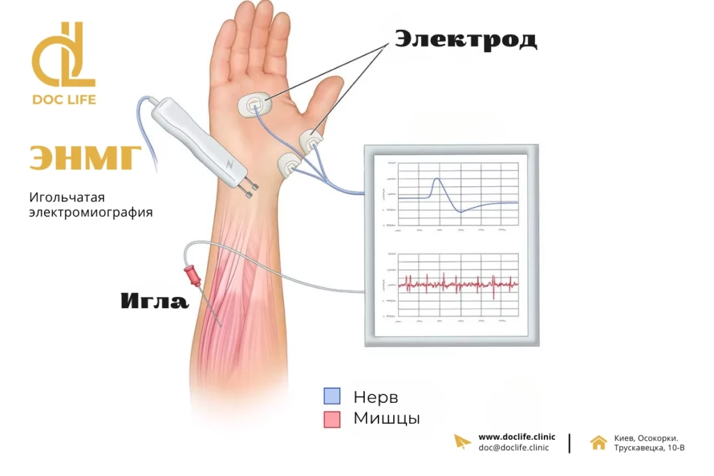Игольчатая электромиография ЭМГ в Киеве 2