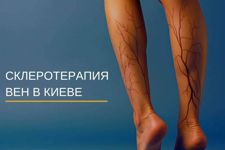 Склеротерапия Склеротерапия – эффективное безоперационное лечение варикозного расширения вен Склеротерапия Склеротерапия – эффективное безоперационное лечение варикозного расширения вен