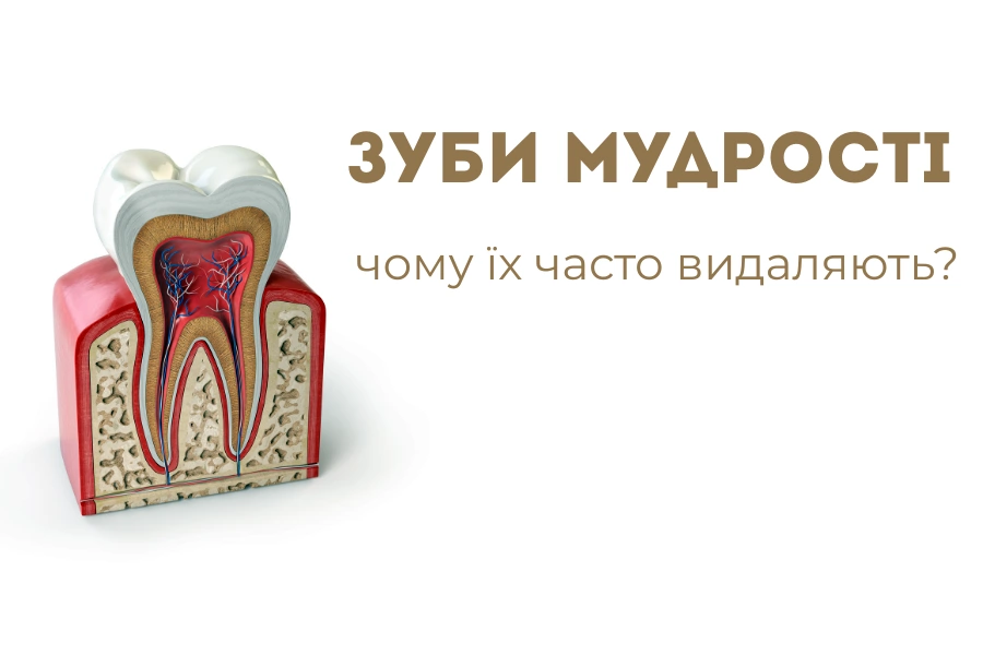 Что такое зубы мудрости и почему их часто удаляют? Что такое зубы мудрости и почему их часто удаляют?
