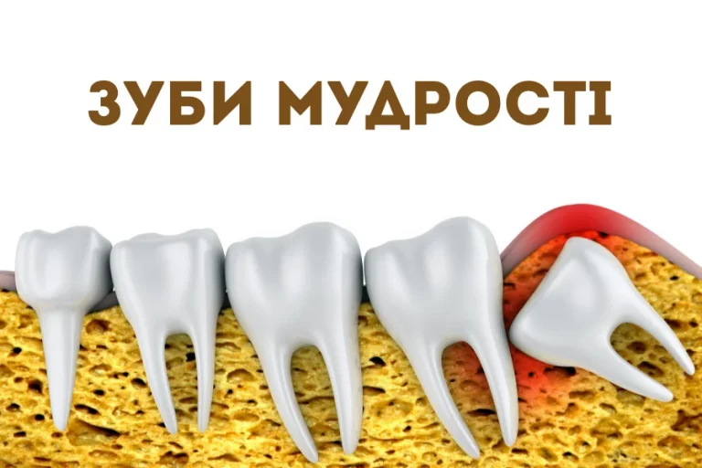 Зуб мудрості Київ