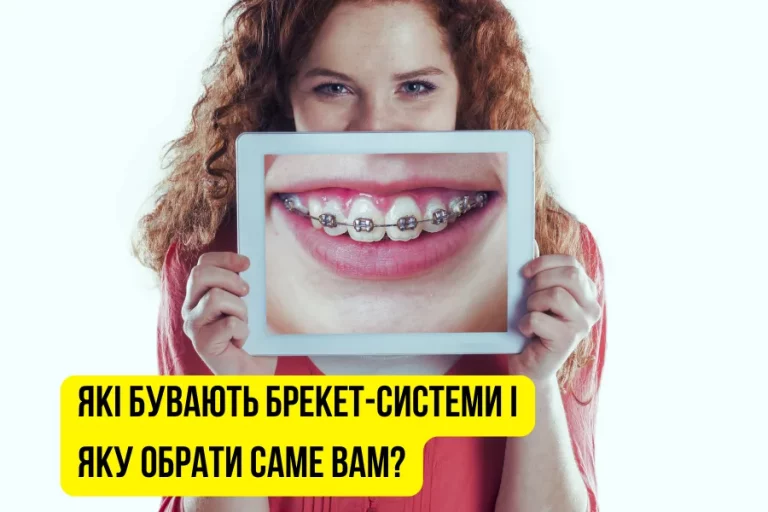 Які бувають брекет-системи і яку обрати саме вам?