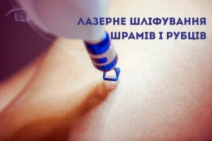 зберегти красу Лазерне шліфування рубців: як позбутися післяопераційних та акне-рубців Лазерная шлифовка рубцов: как избавиться от послеоперационных и акне-рубцов