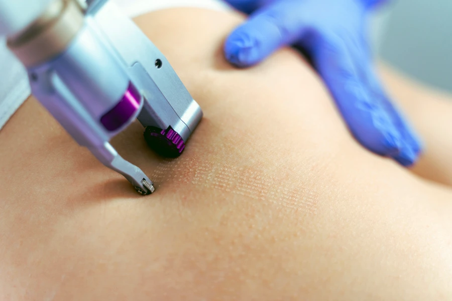 лазерне шліфування шрамів і рубців Довірте свою шкіру професіоналам